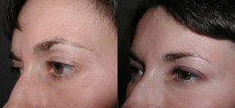 Eyelid Lift - Chatham Facial Plastic Surgery