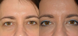 Eyelid Lift - Chatham Facial Plastic Surgery