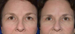 Eyelid Lift - Chatham Facial Plastic Surgery