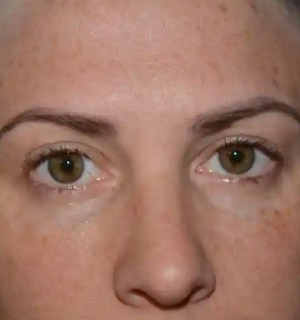 home-eyelid-surgery-after