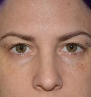 home-eyelid-surgery-before