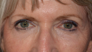 After Eyelid Lift