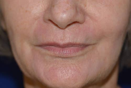 Chemical Peel After, New Albany, IN and Louisville, KY