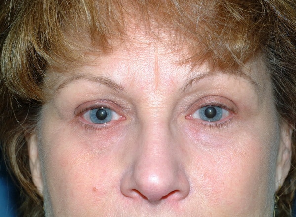 Chemical Peel After, New Albany, IN and Louisville, KY