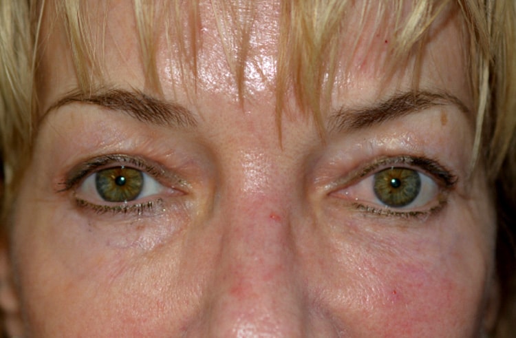 Chemical Peel Before, New Albany, IN and Louisville, KY