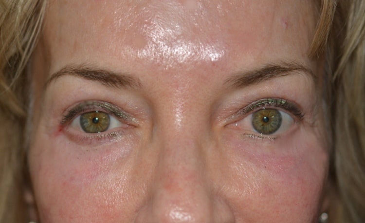 Chemical Peel After, New Albany, IN and Louisville, KY