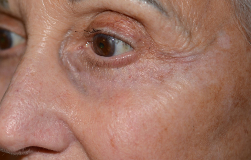 Chemical Peel After, New Albany, IN and Louisville, KY