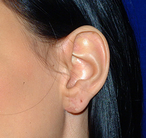 Ear Reshaping After