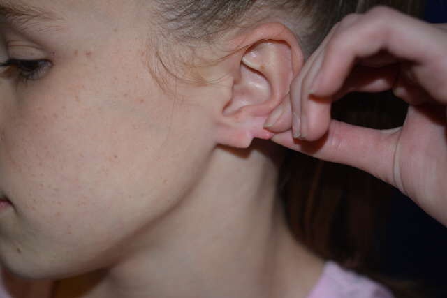 Ear Reshaping Before