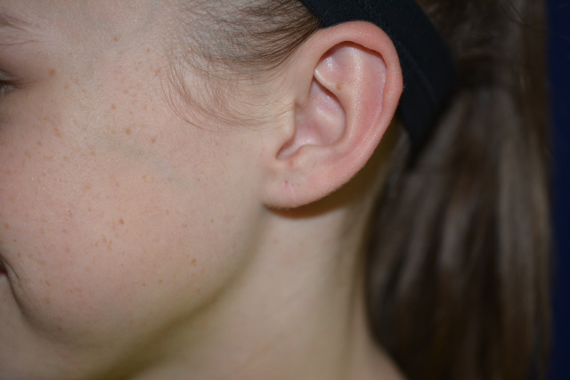 Ear Reshaping After