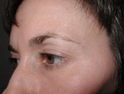 Eyelid Lift Before