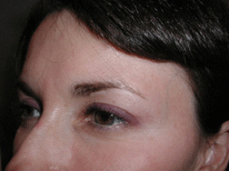 Eyelid Lift After