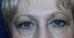 Eyelid Lift Before