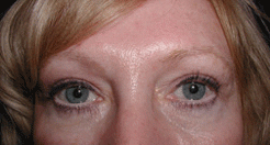 Eyelid Lift After