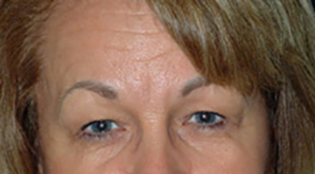 Eyelid Lift Before