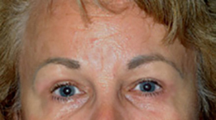 Eyelid Lift After