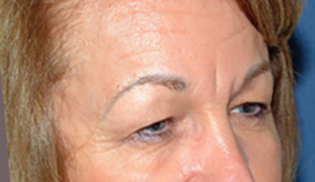 Eyelid Lift Before