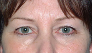 Eyelid Lift Before