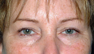 Eyelid Lift After