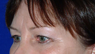 Eyelid Lift Before