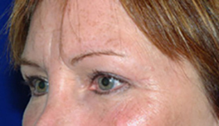 Eyelid Lift After