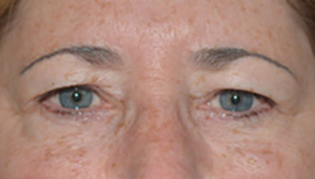 Eyelid Lift Before