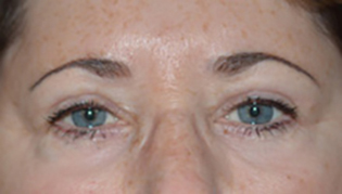 Eyelid Lift After