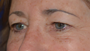 Eyelid Lift Before