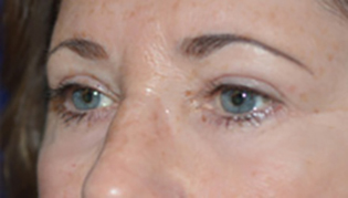 Eyelid Lift After