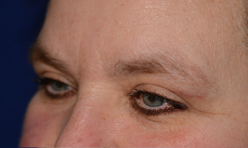 Eyelid Lift After