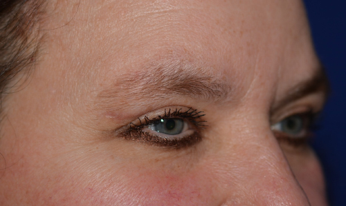 Eyelid Lift After