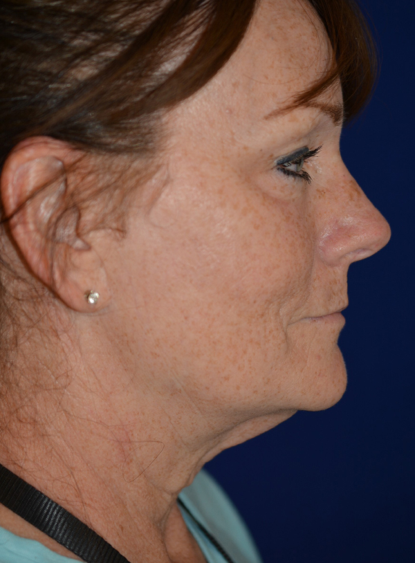 Facelift & Neck Lift Before