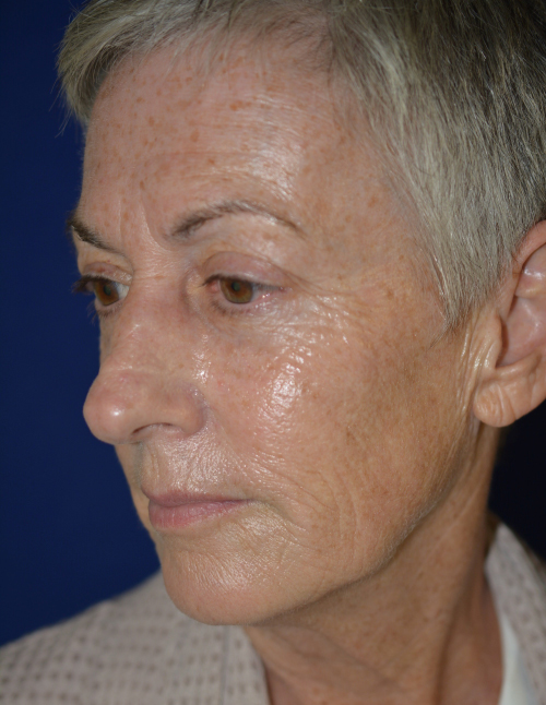 Sculptra® Aesthetic Before