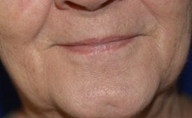 Lip Enhancement Before