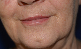 Lip Enhancement After