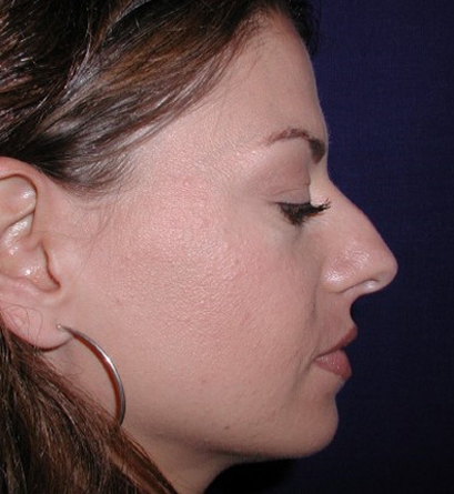 Nose Reshaping Before