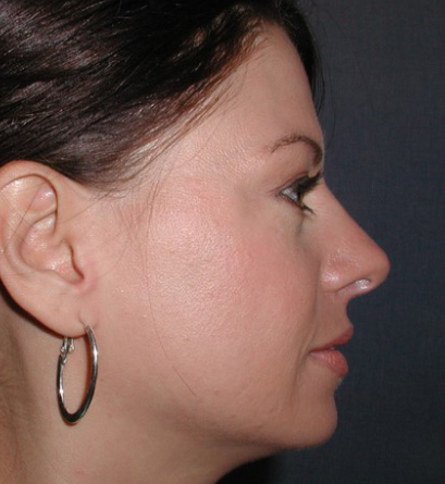 Nose Reshaping After