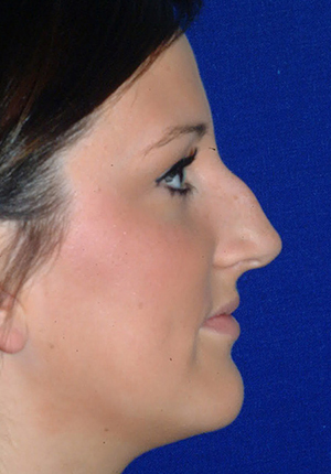 Nose Reshaping Before