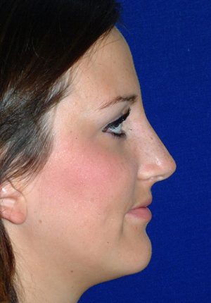 Nose Reshaping After
