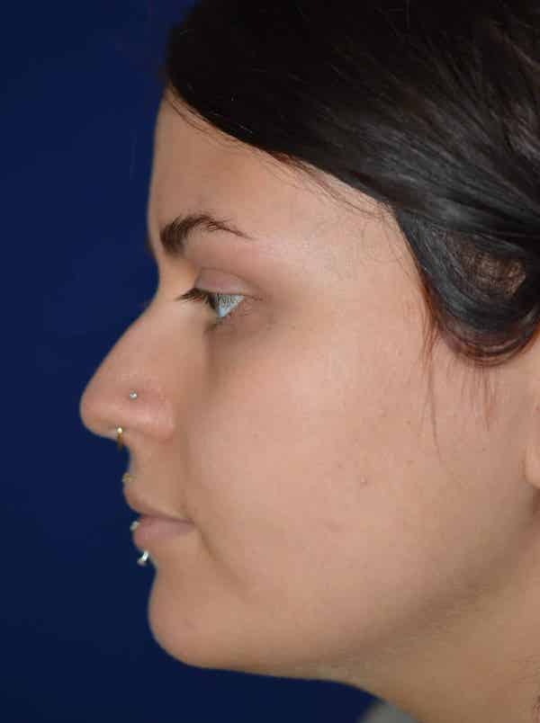 Nose Reshaping Before