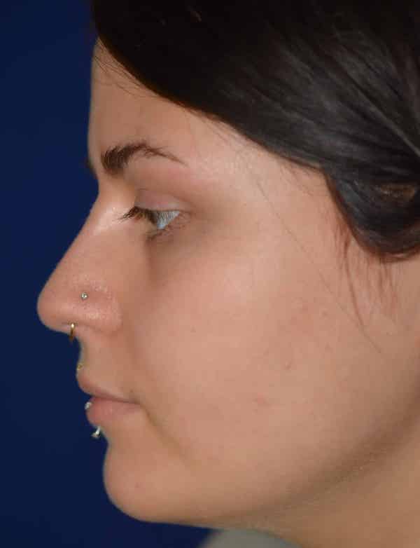 Nose Reshaping After