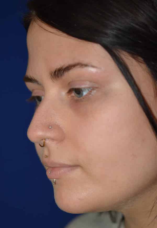 Nose Reshaping Before