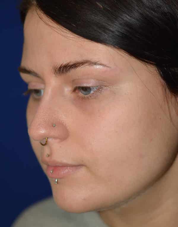 Nose Reshaping After