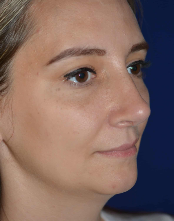 Nose Reshaping - Chatham Facial Plastic Surgery