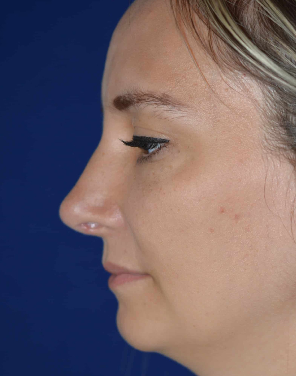 Nose Reshaping After