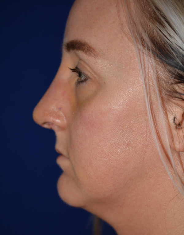 Nose Reshaping After