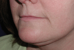 Restylane® Before