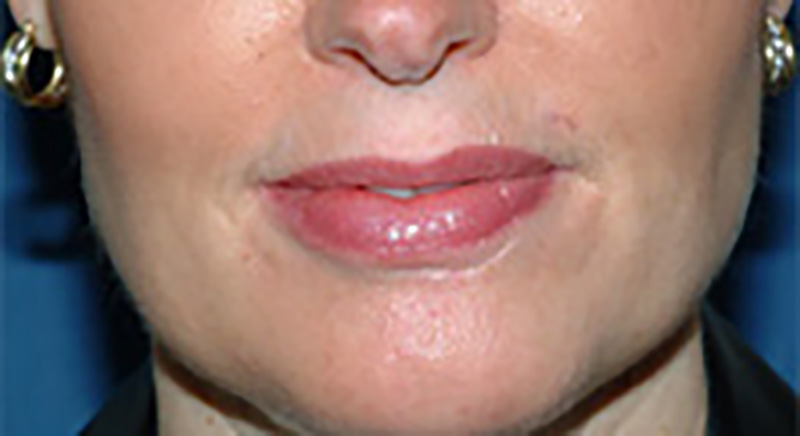 Restylane® Before