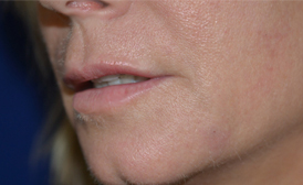 Lip Enhancement with Restylane®