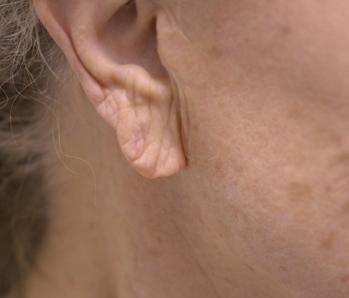 Ear Augmentation with Restylane®